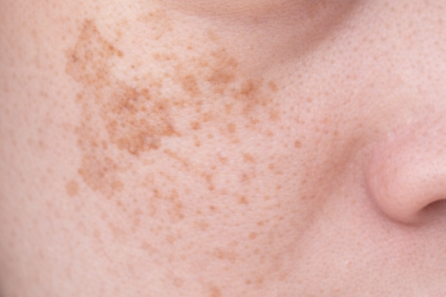 Trước điều trị - Phác đồ nám