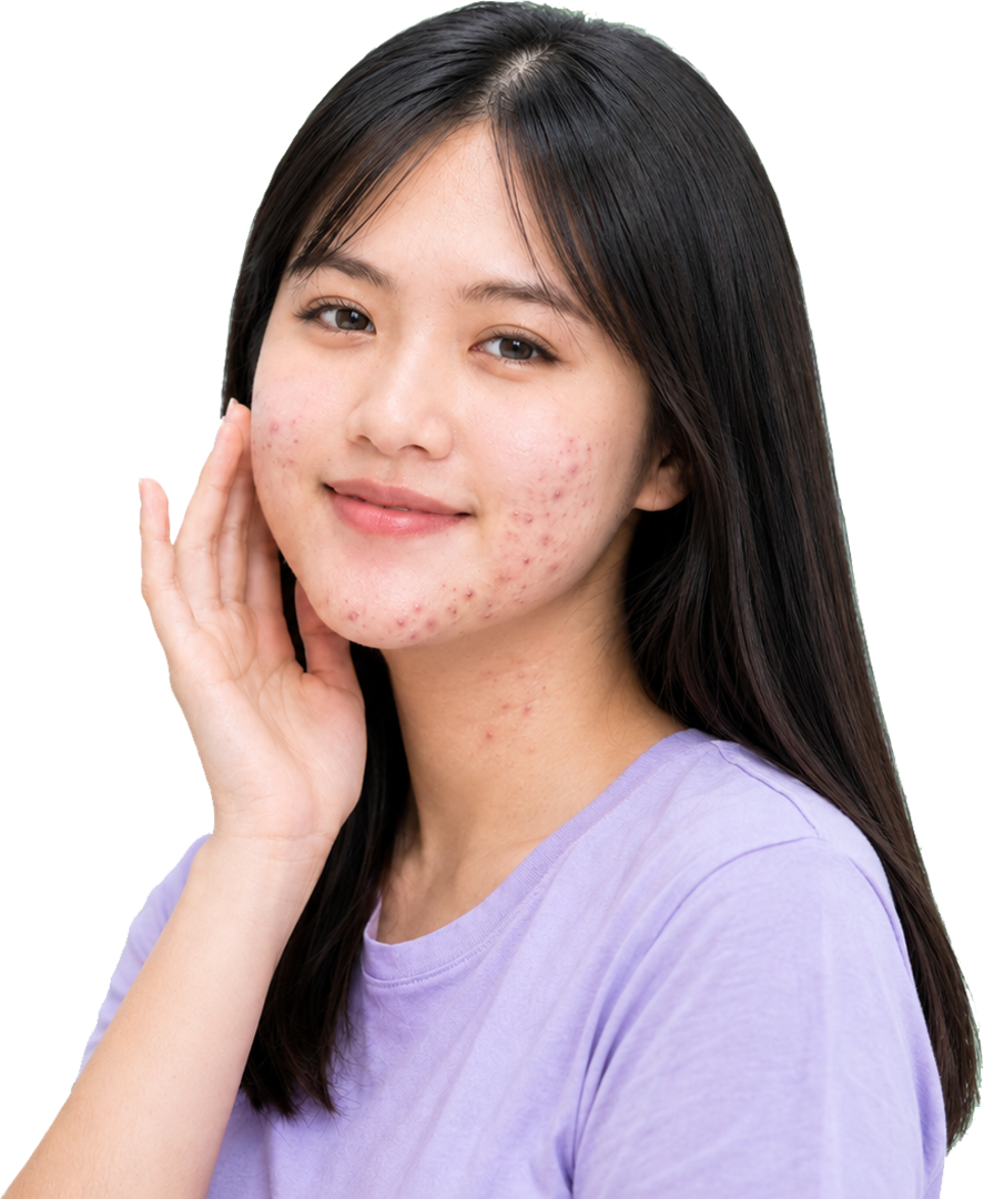 Mụn và các thể mụn thường gặp