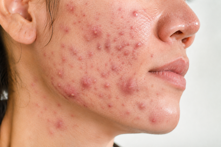 Mụn nội tiết – vì sao hay tái phát dù đã skincare rất kỹ?