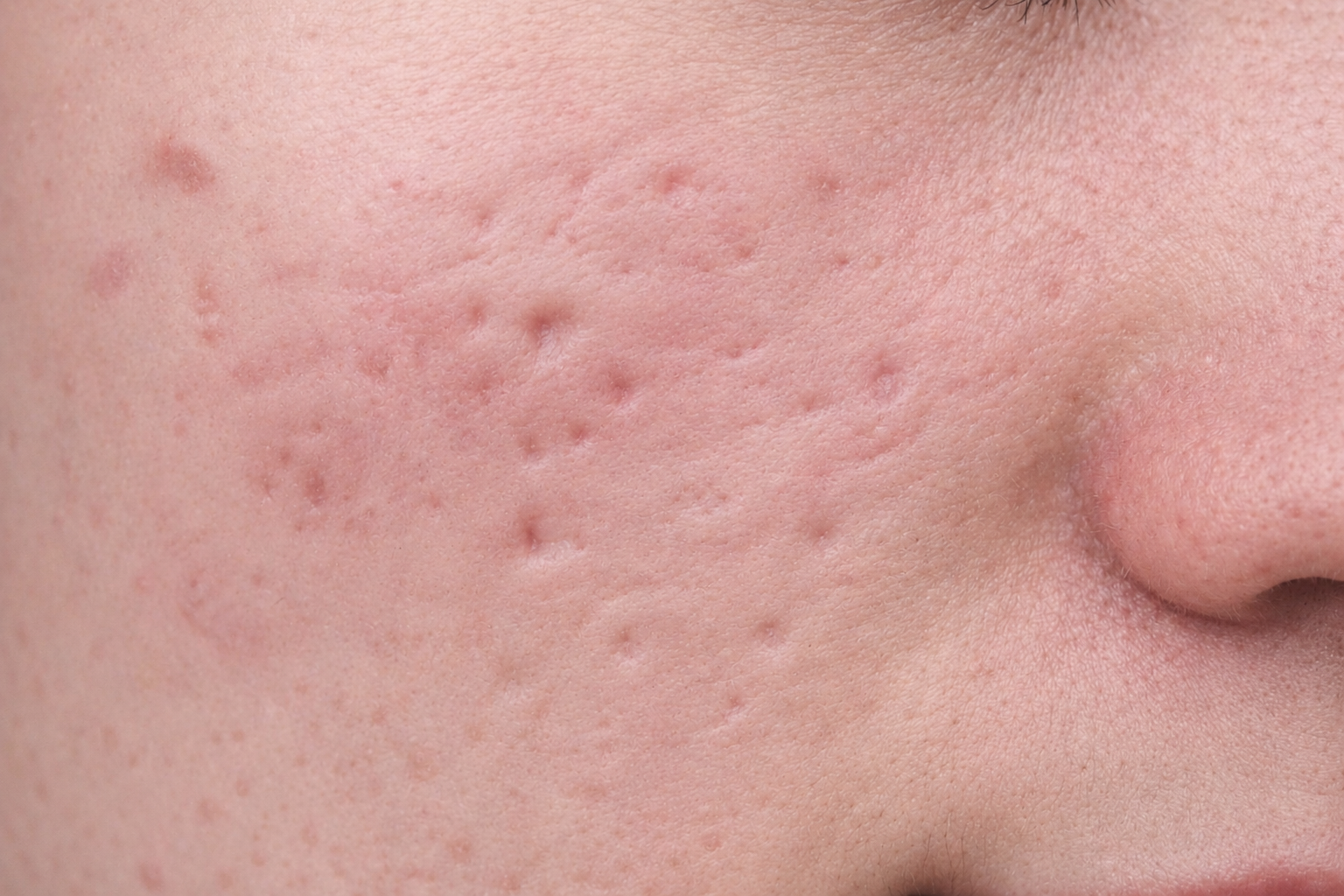 Phác đồ trị sẹo